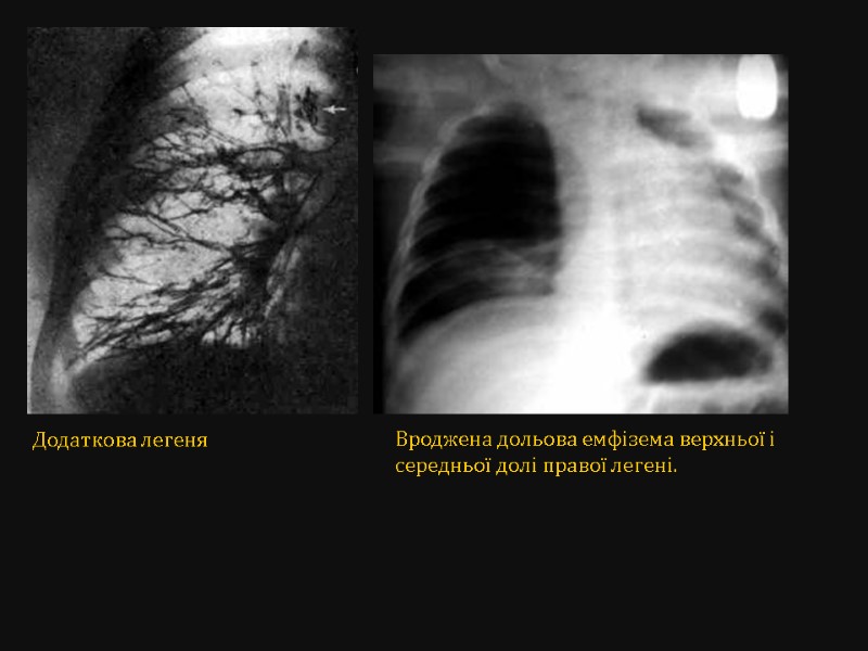 Додаткова легеня     Вроджена дольова емфізема верхньої і середньої долі правої